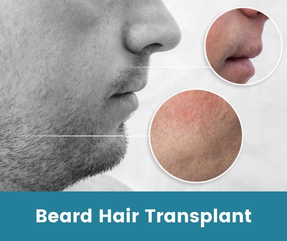 Beard and Moustache Transplantation in Delhi
