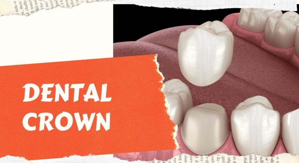 Dental Crown Bridges and Veneers Treatment in Delhi, India