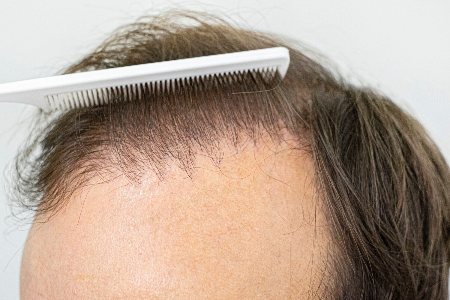 Failed Hair Transplant Repair Center