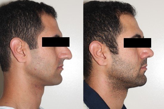 Rhinoplasty-gurgaon