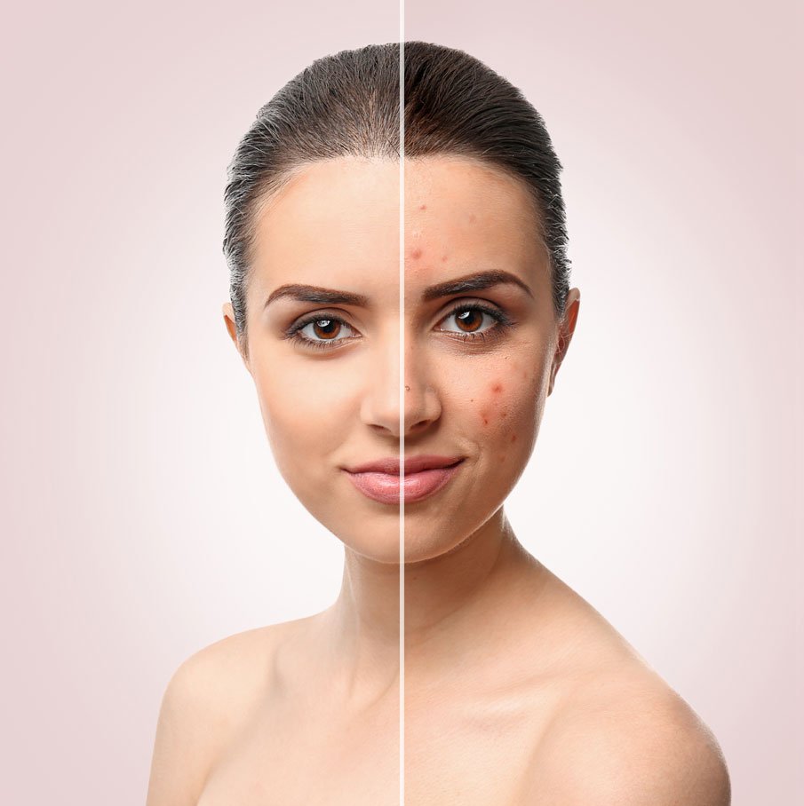 Acne Treatment In Bangalore