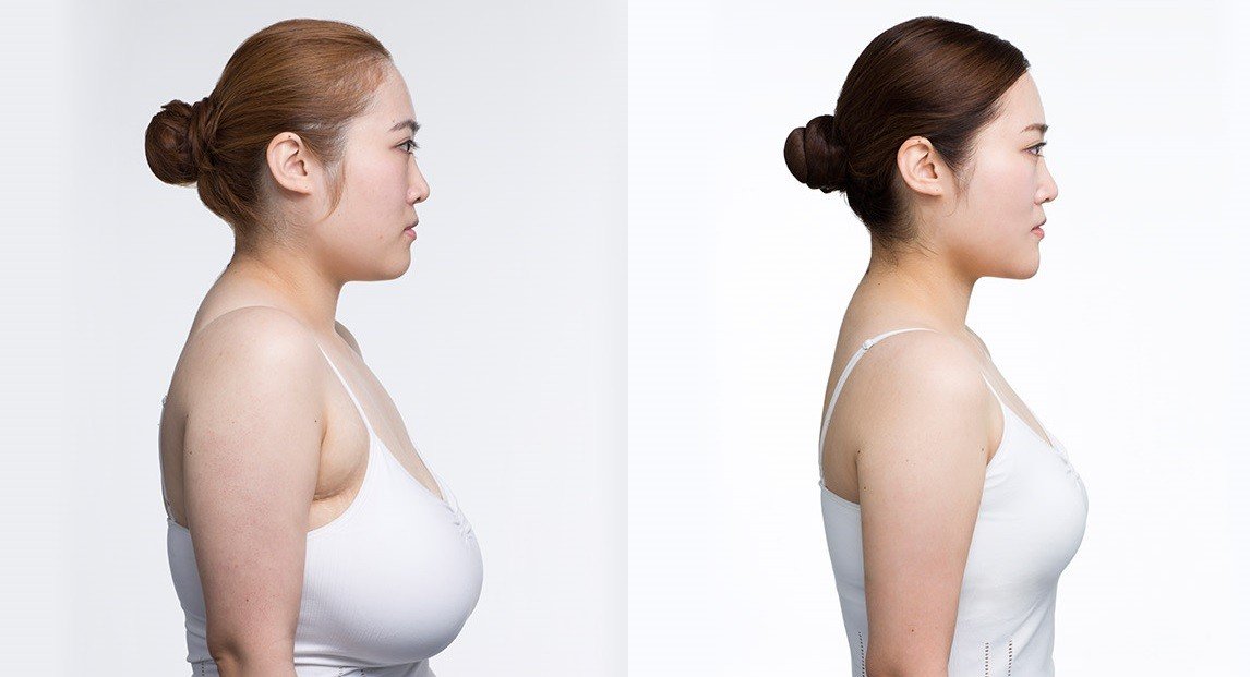 Female Breast Reduction Surgeon in Gurgaon