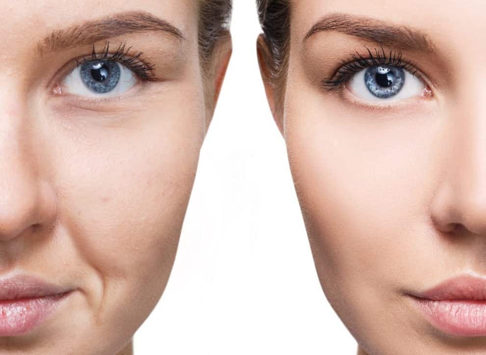 Fat Grafting Surgery in Gurgaon, Delhi NCR
