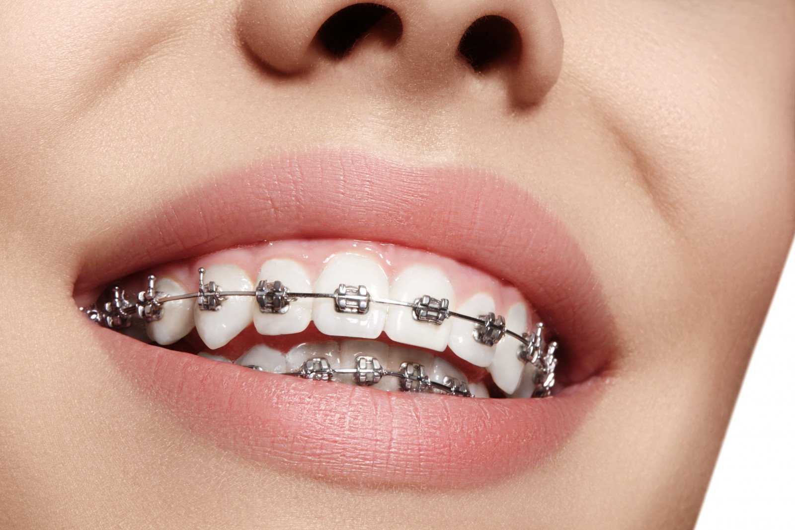 Dental Braces Clinic Delhi